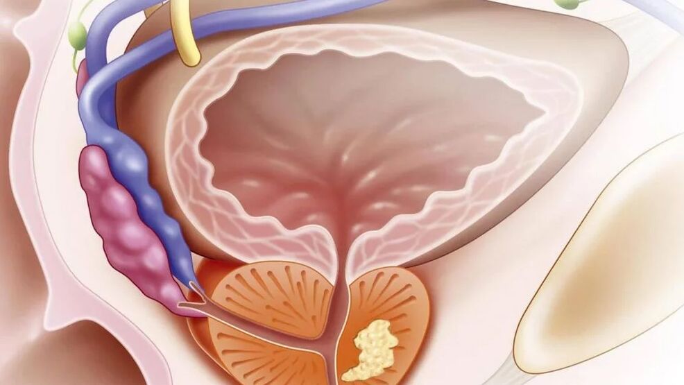 Chronic nebacterial prostatitis