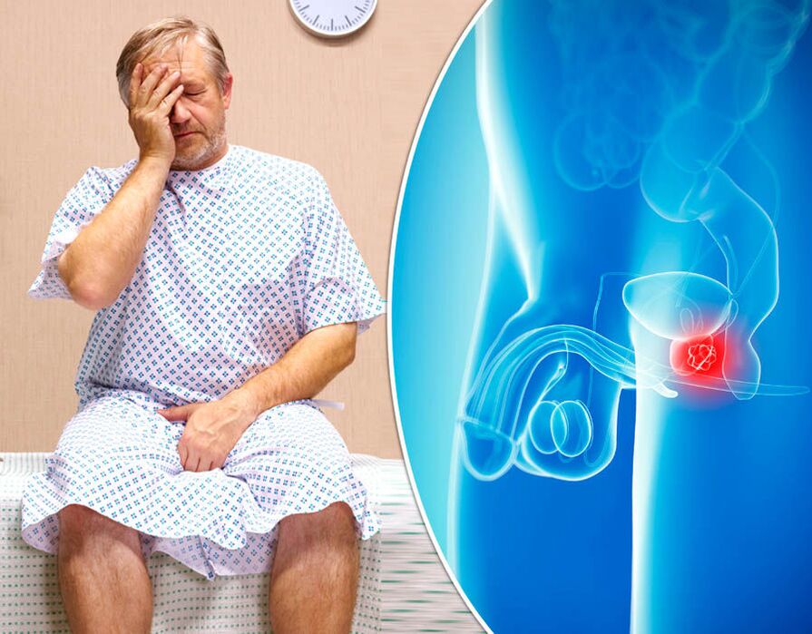 A man with prostatitis underwent a diagnosis of the disease