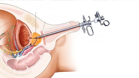 Prostatitis surgery treatment