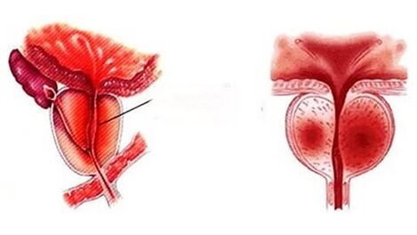 What does a chronic prostatitis look like
